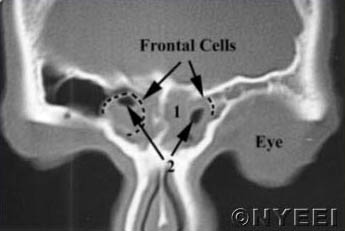 Frontal Sinusotomy - NYEE